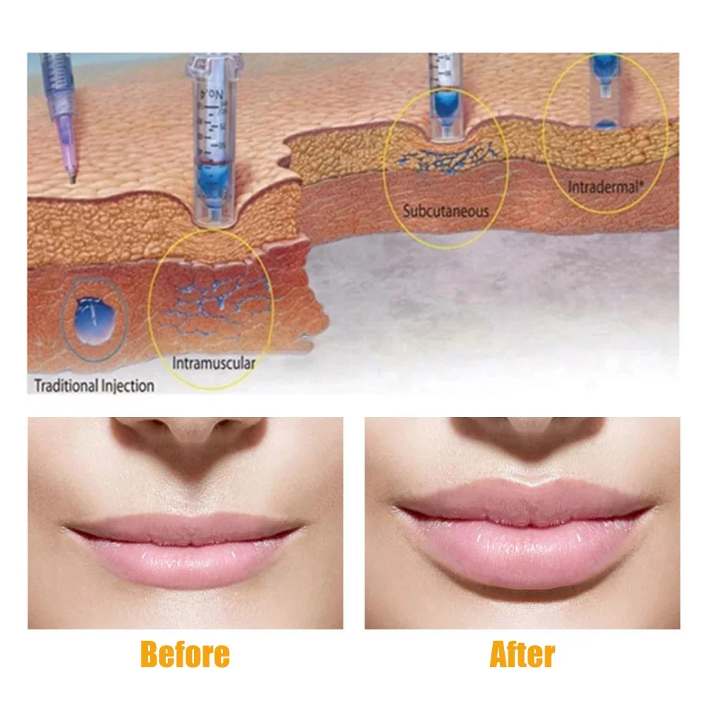 0.3ml Hyaluron Pen High Pressure Hyaluronic Pen Gun Anti Wrinkle Lip Lifting Atomizer Skin Lip Injection Machine Portable