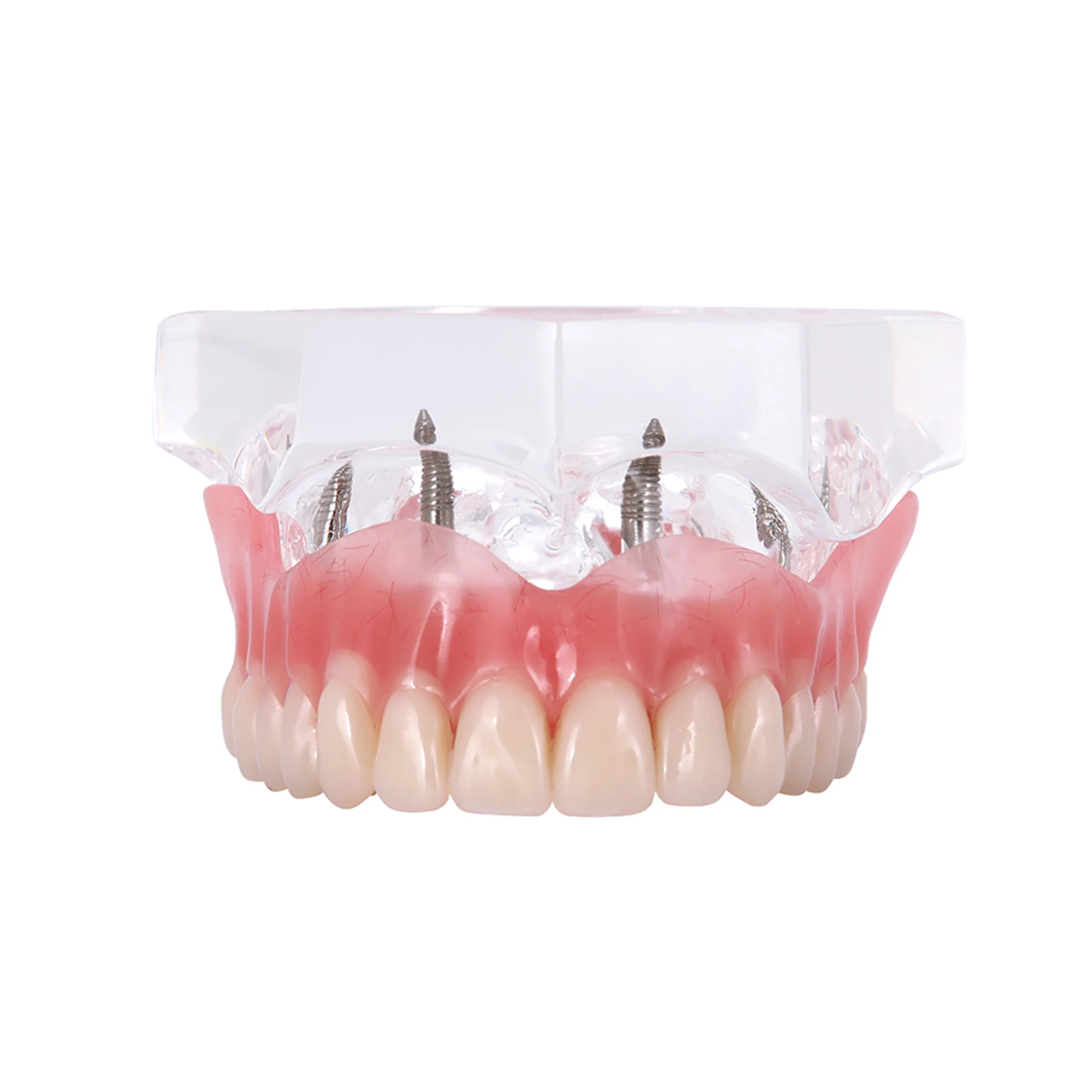 

Dental 4 Implant Teeth Model Demo Removable Overdenture Restoration Upper