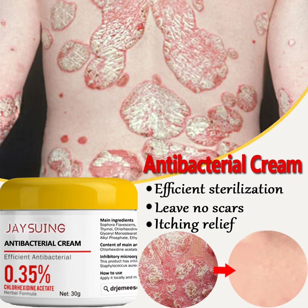 Psoriasis Moisturizing Cream Natural Repair Effectively Antibacterial