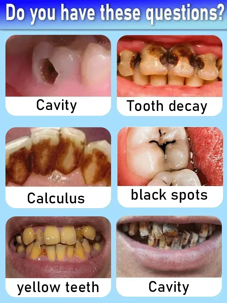 Effective Teeth Whitening Tooth decay repair Calculus Plaque Periodontitis Remove Cavities For teeth whitening product,teeth whitening essence,teeth health product