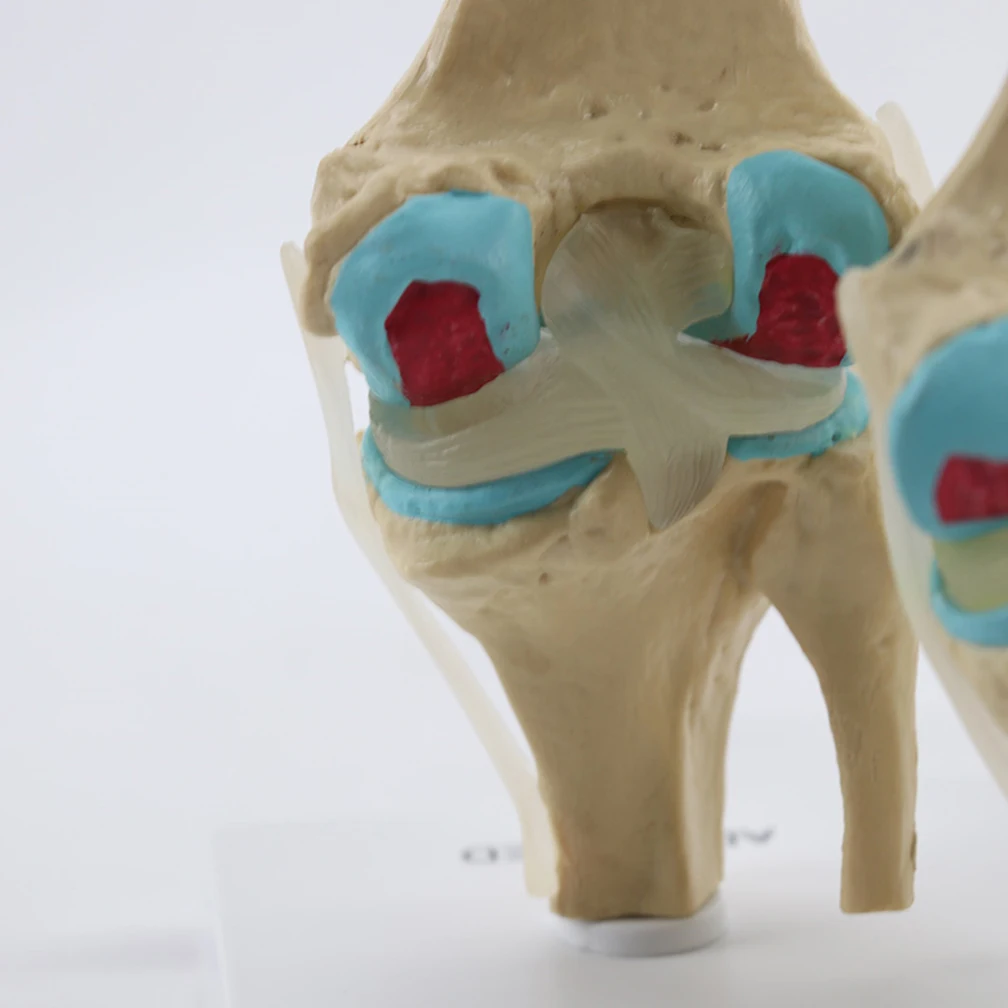 Four-Stage Human Pathological Knee Joint Anatomy Model Medical Science Teaching Resources Kit Models Dropshipping