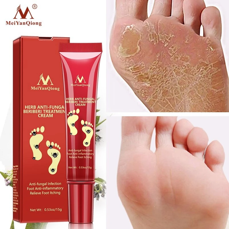 Herbal Foot Treatment Anti Fungal Infection Onychomycosis Paronychia