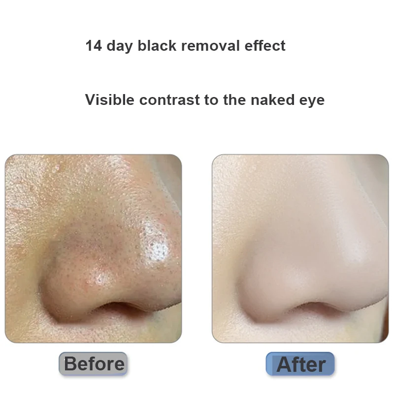 Ultrasonic Face Cleaning Skin Scrubber Facial Cleaner Skin Peeling Blackhead Removal Pore Cleaner Face Scrubber