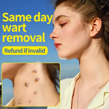 Crème anti-verrue naturelle, formule à base de plantes, rapide, indolore, douce, non irritante, sûre et efficace