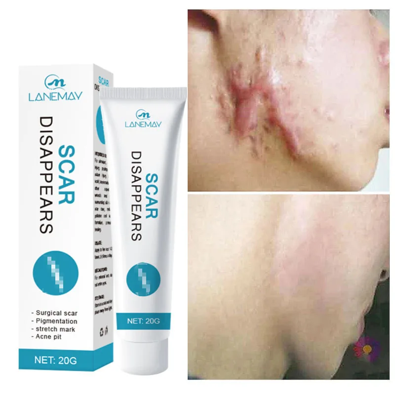 Acne Scar Removal Cream Herbal Repair Stretch Marks Burn Surgical Acne Scar Gel Smooth