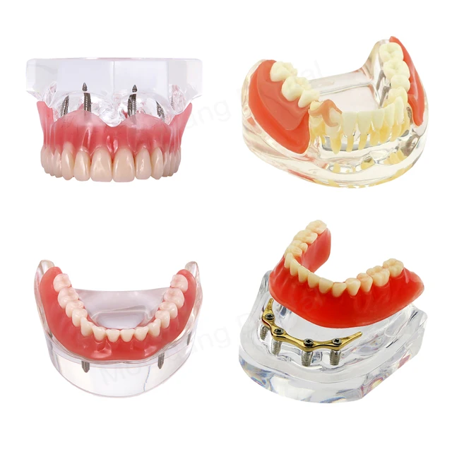 Dental Model with Removable and Restorable Teeth Dental Education Model Implant Overdenture Teeth for Researching Medical