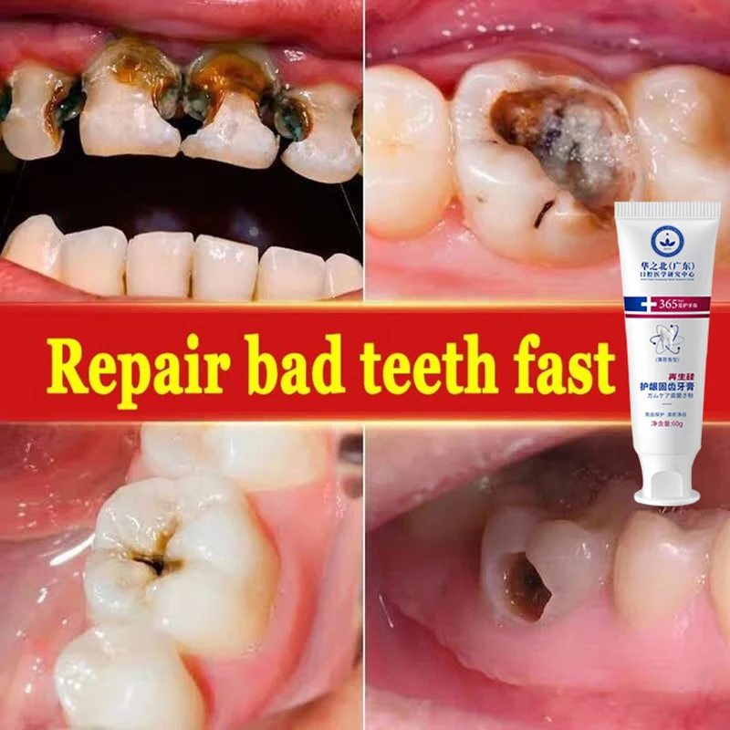 New Upgrade Quick Repair of Cavities Caries Removal of Plaque Stains Decay Whitening Yellowing Repair Teeth Teeth Whitening 3