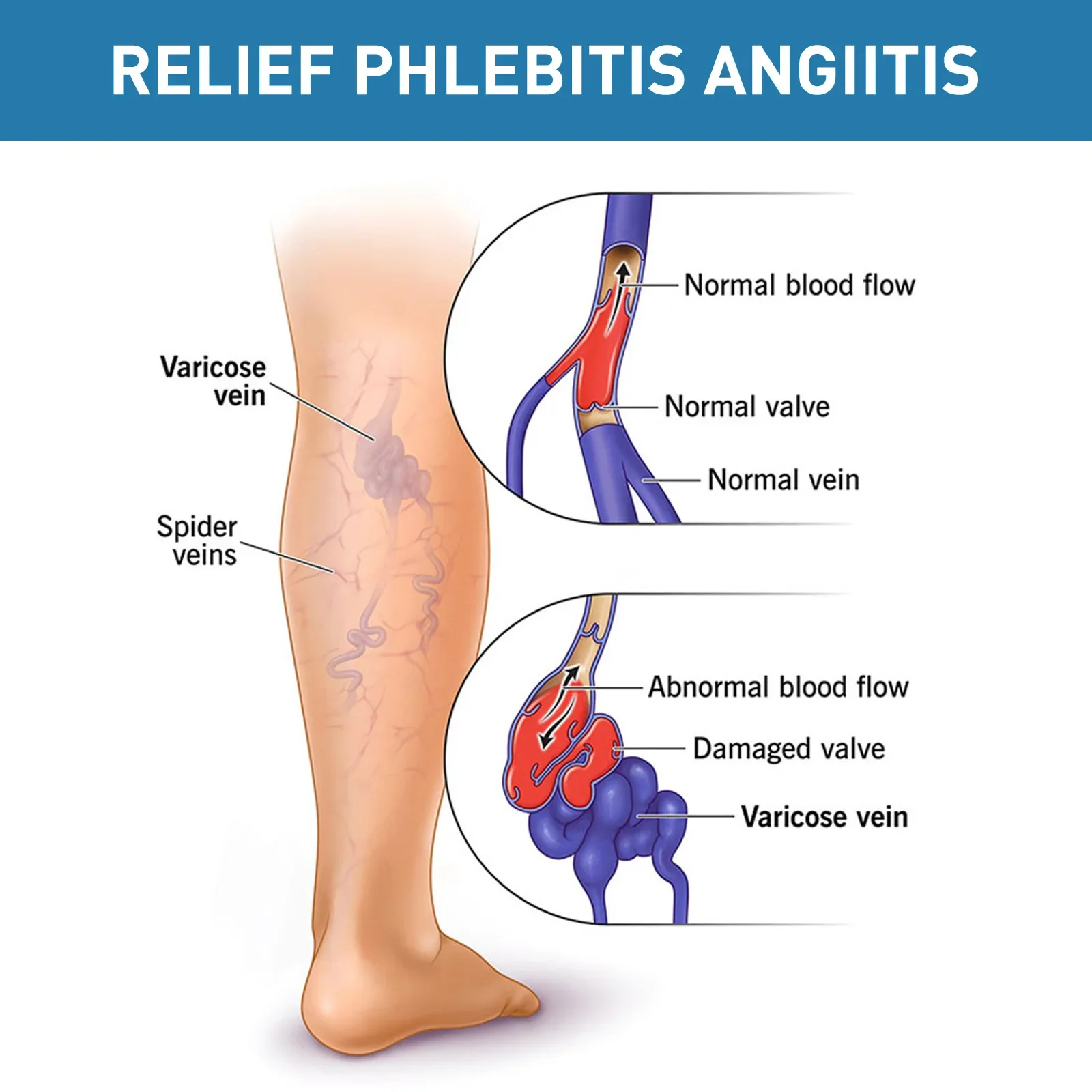 Relieve Vasculitis Cream Phlebitis Worm Spider Legs Vessel Pain Treatment Soothing Reduce Swelling Varicose Vein Relief Ointment 3