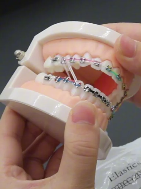 2000 Élastiques Orthodontiques Pour Appareil Dentaire - Lot De 3 - Couleurs Mélangées - Neuf