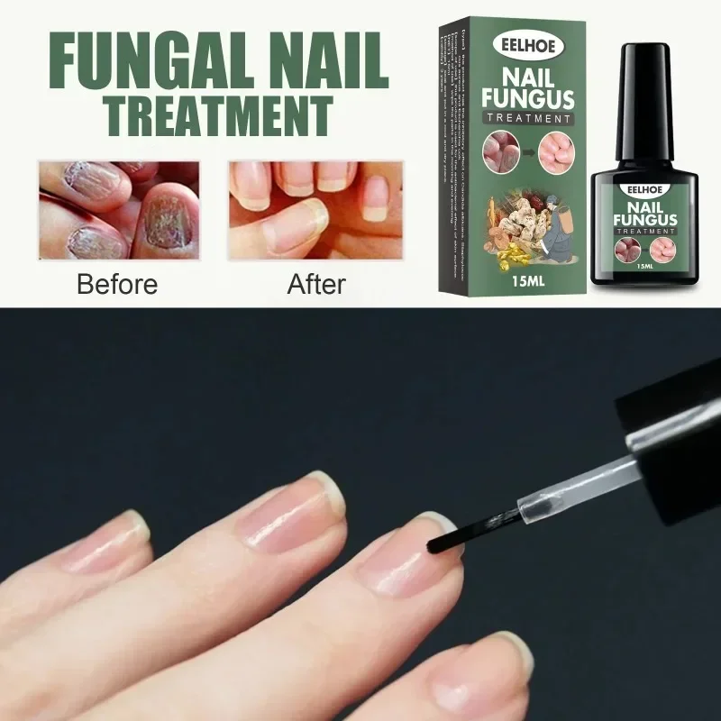 Nail Fungal Treatment Serum for Toe Nail Fungus Removal, nail fungus remover,personal health care,manicure pedicure tools