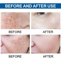 Dark Spot Remover Kojic Acid Serum Sun Spot Freckles Melasma Brown Spot Whitening Moisturizing Facial Glowing Skin Care Beauty 5