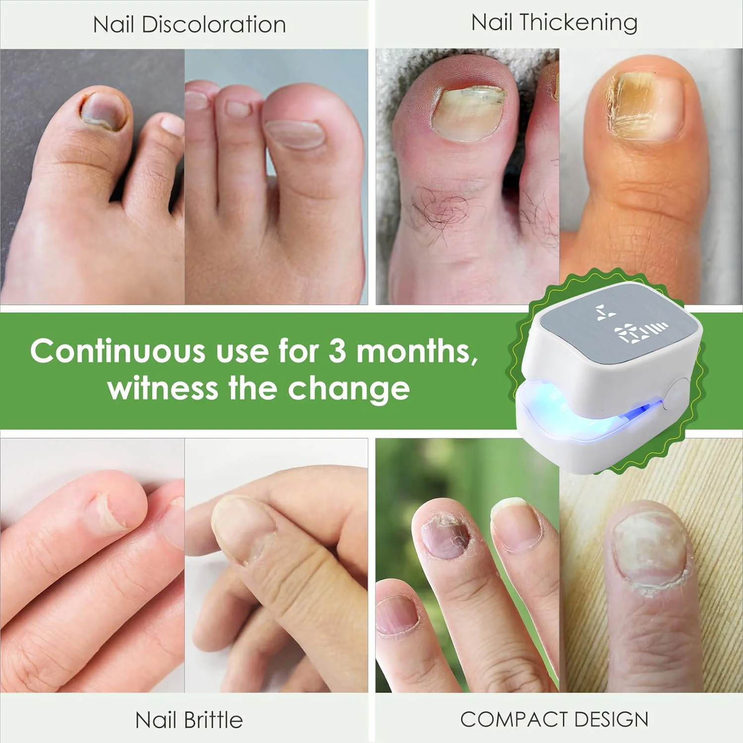 Laser Treatment Nail Problem Solving Nail Laser Repair Fast Nail Fungus Onychomycosis Fungus Nail Laser Device Cleaning Laser Device Remove Cure Ingrown Tool