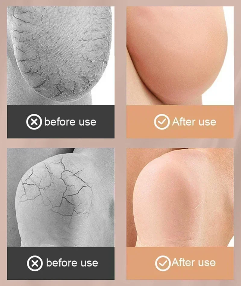Heel Patch Insole Heel Protector Heel Protector Pads Heel Insoles Heel Cushion Insole Heel Cushion Protector Heel Protector Patches Heel Socks Gel Silicone Heel Protector Sleeve Heel Pads Cups Plantar Fasciitis Support Feet Care Skin Repair Cushion Half-yard Socks