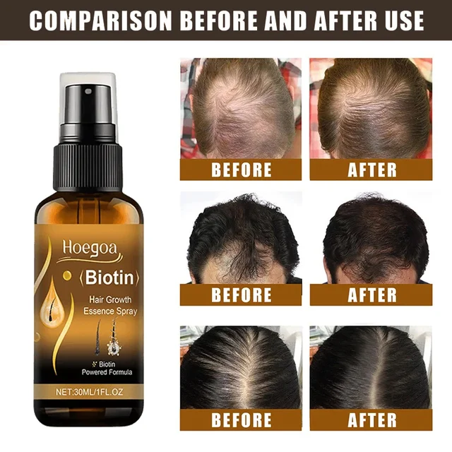 46218-811808.jpg Biotin Fast Hair Growth Spray Anti Hair Loss Serum Prevent Baldness Treatment Scalp Beard Beauty Essence Hair Care Products 30ml