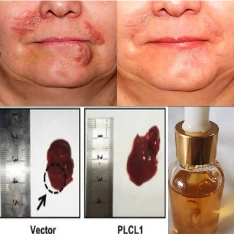 

Advanced Scar Removal Oil for New & Old Scar Acne Surgery Stretch Marks Relief and Burns Repair Serum Body Skin Care