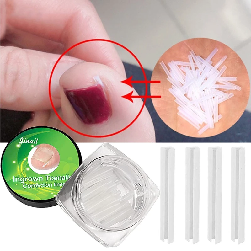10pcs Ingrown Toenail Correction Strips Straightening Clips Paronychia