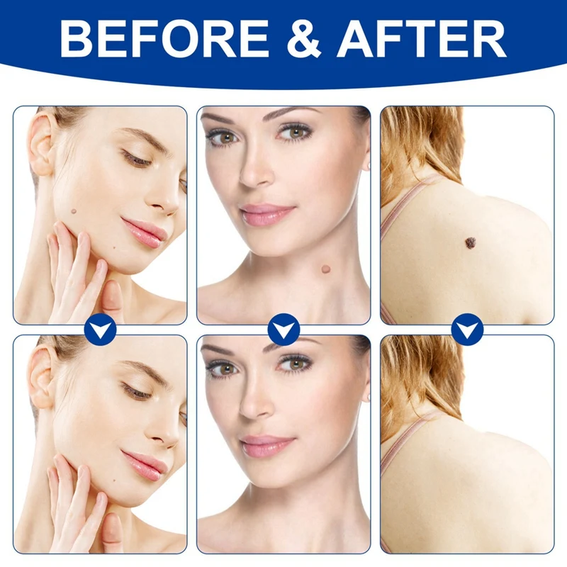 Skin Tag Removal Kit Painless Skin Tag Removal Pen Easy Device Removes 4Mm-9Mm Tags