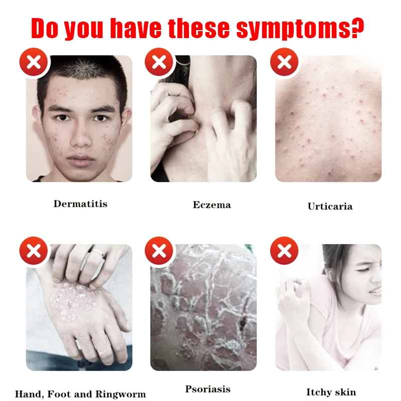 Scorpion Venom Skin Cream Relieve Psoriasis Eczema Allergic Dermatitis Herbal Antibacterial And Antipruritic 20g skin care ointment