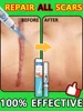 Laser scar repair 1