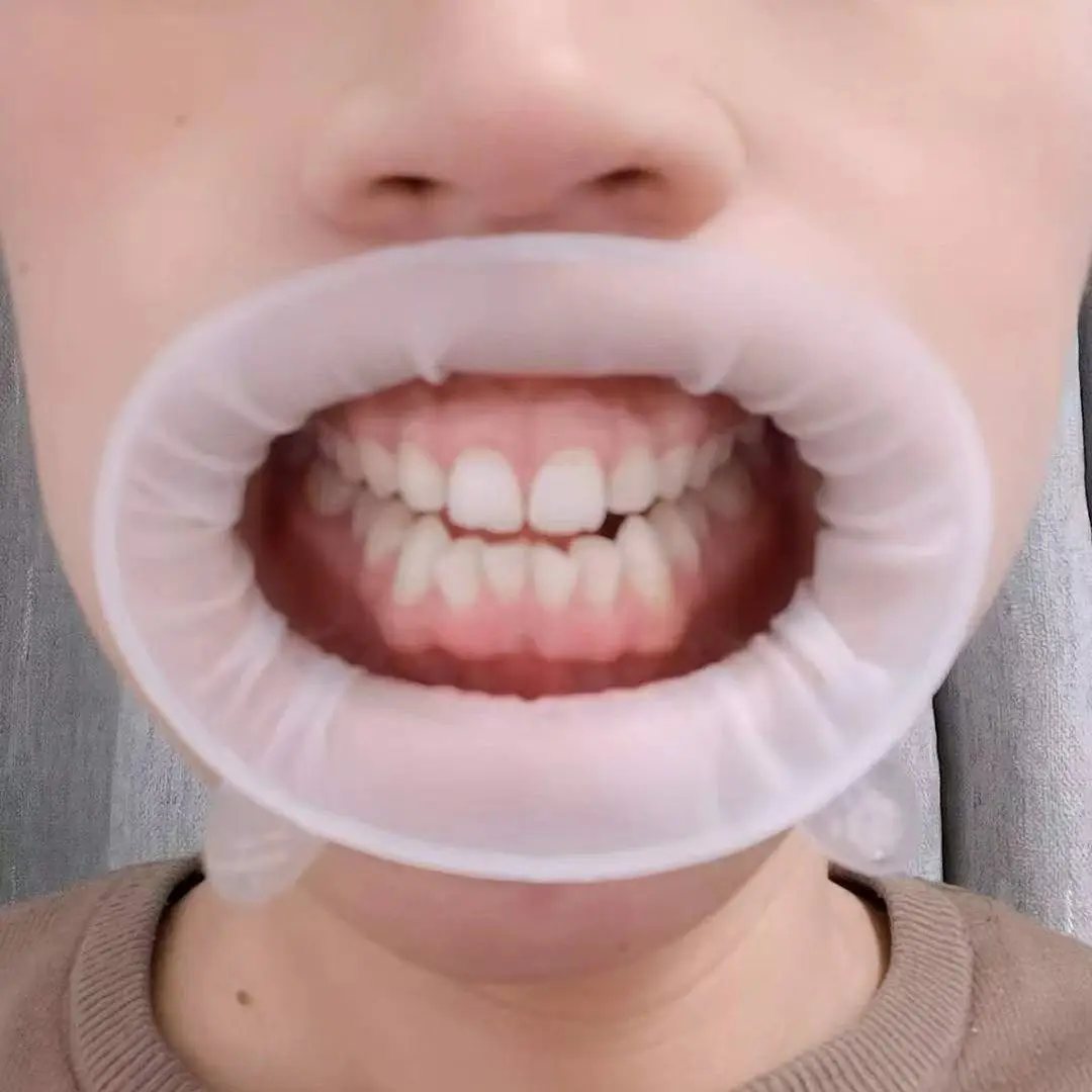 Стоматологический роторасширитель OptraGate | AliExpress