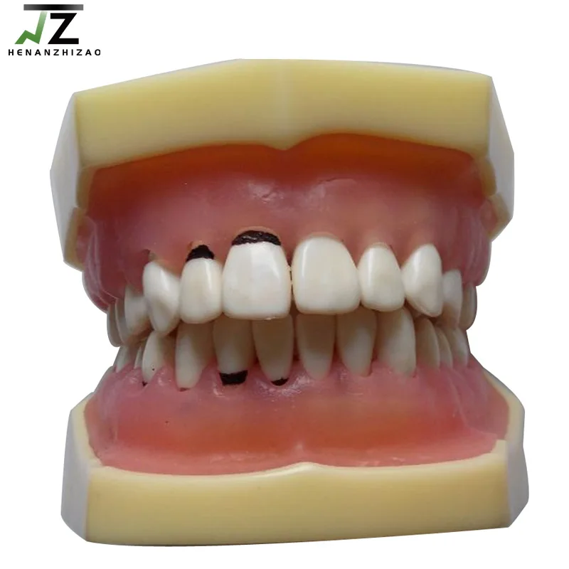 

de ntal Periodontal Disease Pathology Teeth Model for Medical Teaching