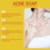 Acne Treatment Soap Pimple Remove Pigment Deep Cleansing Pores Shrink Oil Control Moisturize Body Face Lightening Skin Care Soap 6