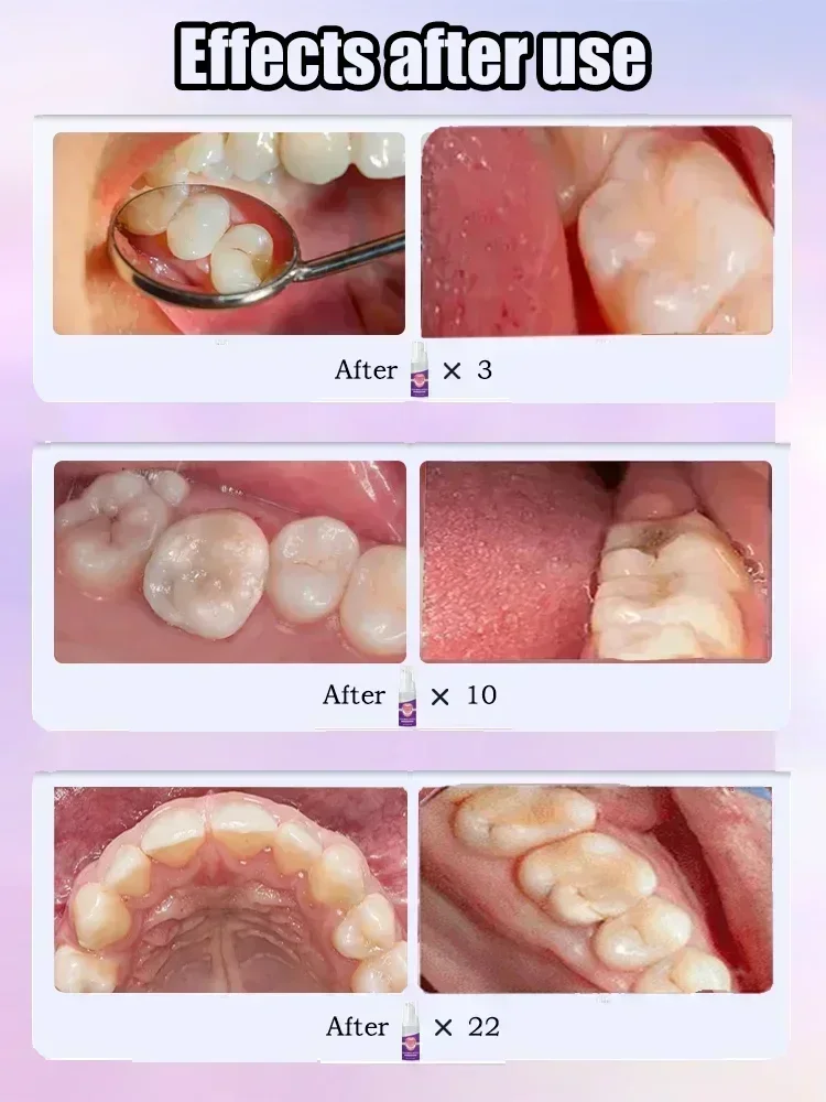 Dental paste Prevent Tooth Decay Dental Caries Whitening Teeth Fresh Breath Repair Tooth Decay Teeth Whitening Product Teeth Whitening Essence Teeth Health Product