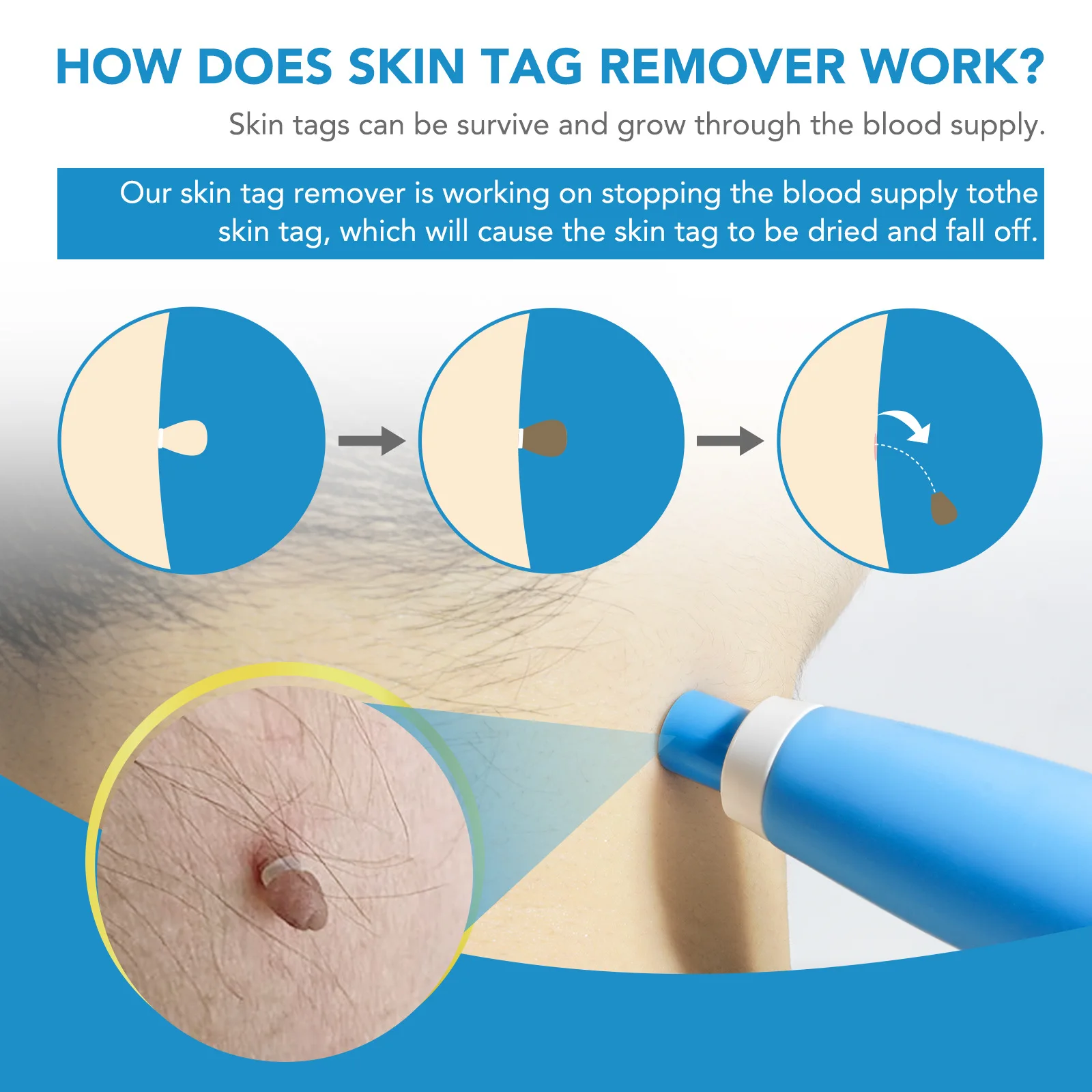 Skin Tag Removal Kit Components