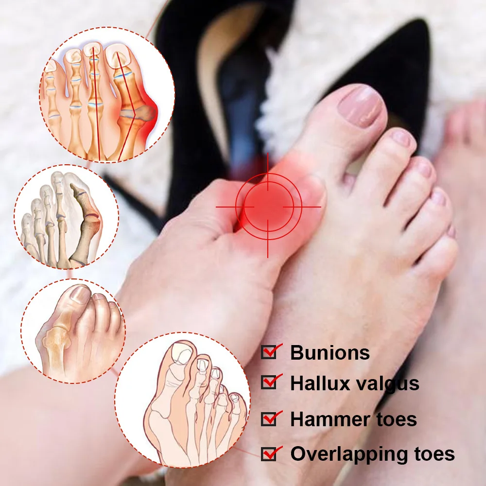 Gout Plaster Toe Bunion Hallux Valgus Pain Relief Care Stickers Finger Thumb Joint Sprain Ache Massage Plaster pain analgesic cream