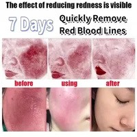 Crème réparatrice pour les rougeurs du visage, améliore la sécheresse des peaux sensibles, Lotion apaisante hydratante, élimination de la rosacea, cosmétiques coréens de jour et de nuit 4