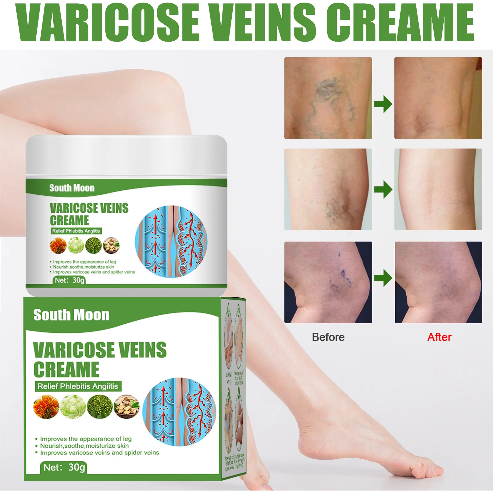 Varicose Veins Relief Vasculitis Phlebitis Pain Relief Ointment Vein