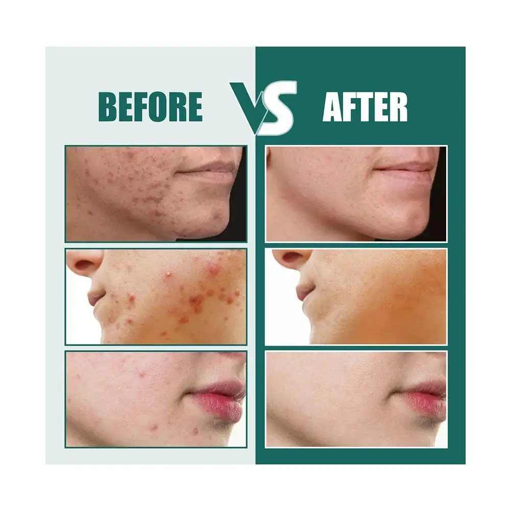 New Star Pimple Patch Stickers Dazzling Colorful Face Acne Removal Skin Spot Sticker Beauty Face Care Care Makeup Tool Conc T3Z1