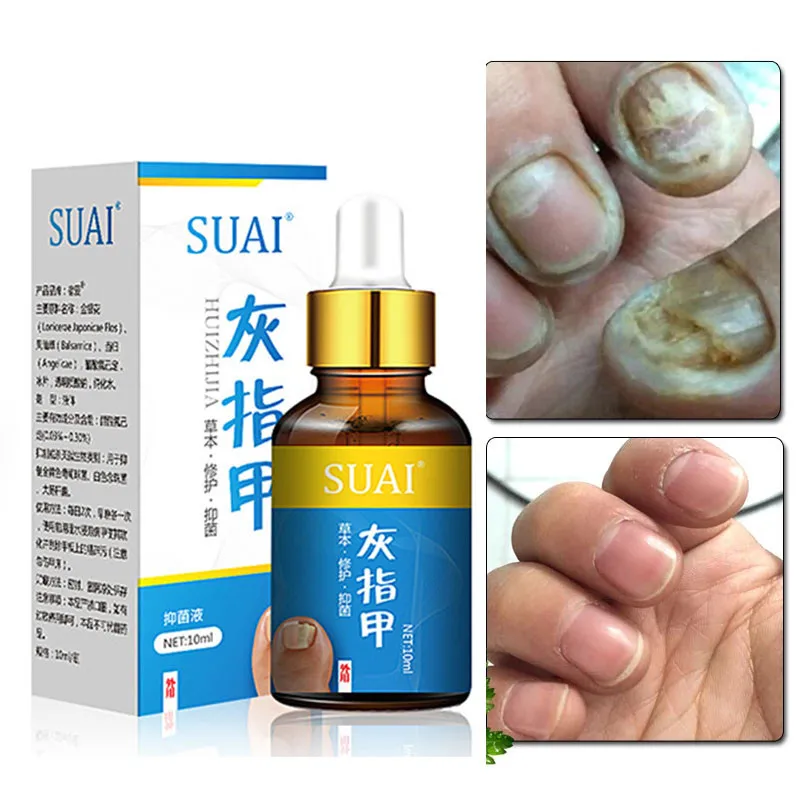 10ml Fungus Nails Serum Essence Hand Foot Toe Nail Fungal Treatment