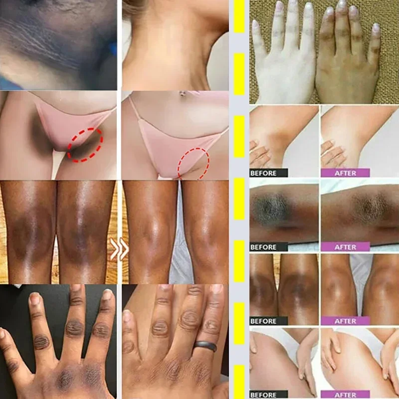 Whitening Cream Private Parts Underarm Bleaching Serum Whiten Butt Knee Brighten Inner Thigh Intimate Parts Dark Remove Melanin 2