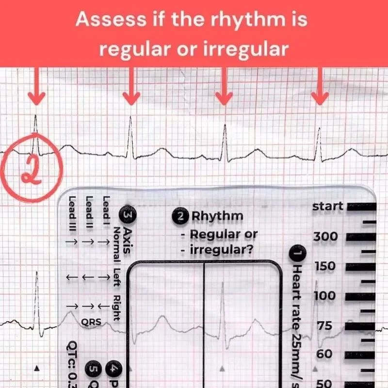 Measurement Tool Ecg 7 Step Ruler 7 Step Scale For Ecg Observation Portable Transparent 7step Ruler Measurement Tool For Interpretation