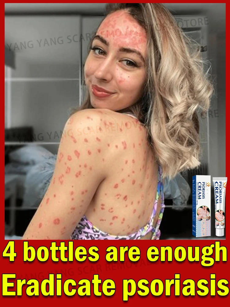 

Psoriasis cream For Repairing Psoriasis on Hands, Feet, Head, Buttocks and body Against psoriasis、Eczema and Dermatitis