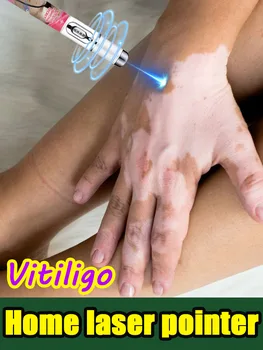 Improve vitiligo laser