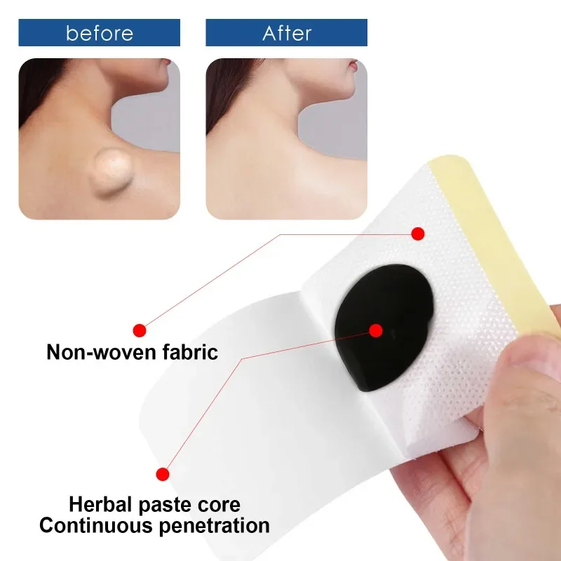 Lipoma Removal Patch Remove Fat Lump Nodular Sticker Anti-Tumor Cellulite Treat Skin Cyst Swelling Pain Relief Medical Plaster