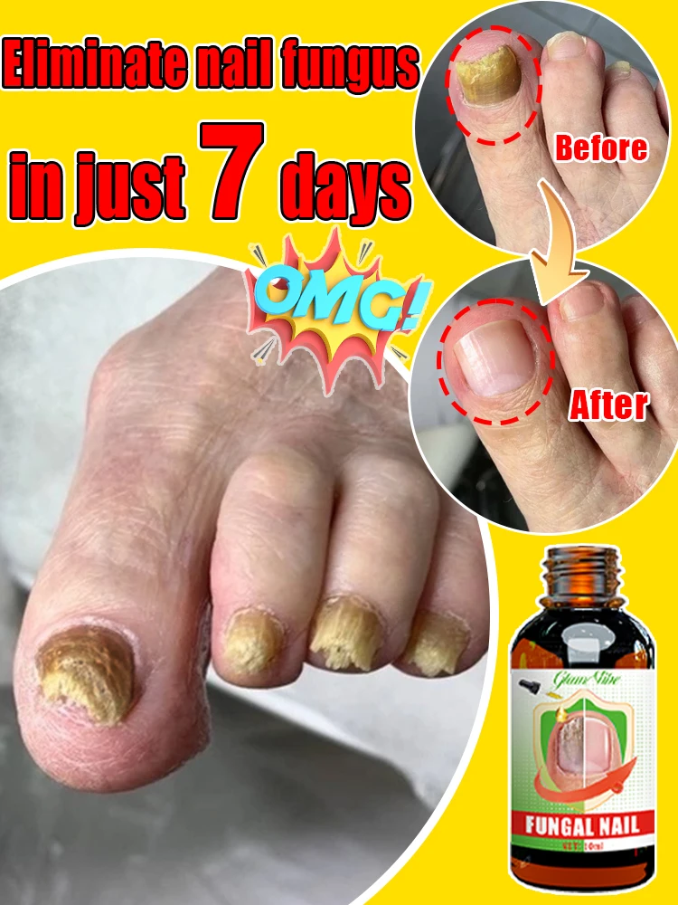 Fungus Solution fungus solution