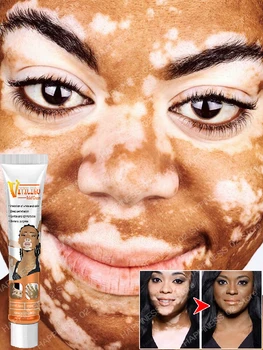 Pommade orale pour éliminer le vitiligo, élimine la teigne, les taches blanches, la peau, les soins de la peau