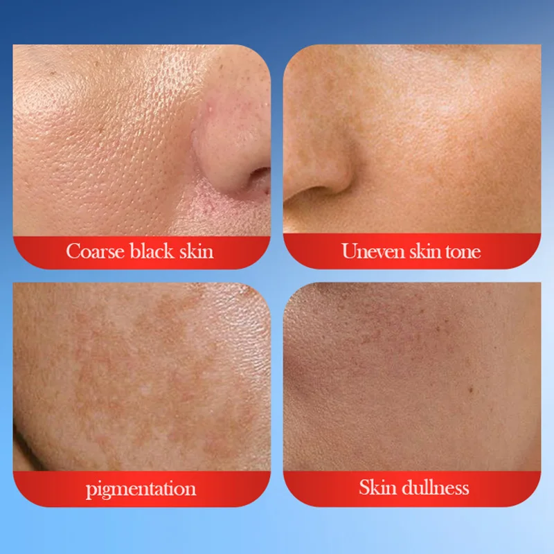 SADOER Anti-Freckle Cream Whitening Creams Spot Freckles Removing Anti-aging Moisturizing Face Serum Facial Skin Care