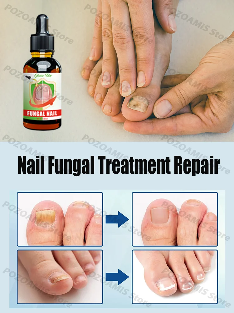 Onychomycosis killer, solve fungal problems, foot care