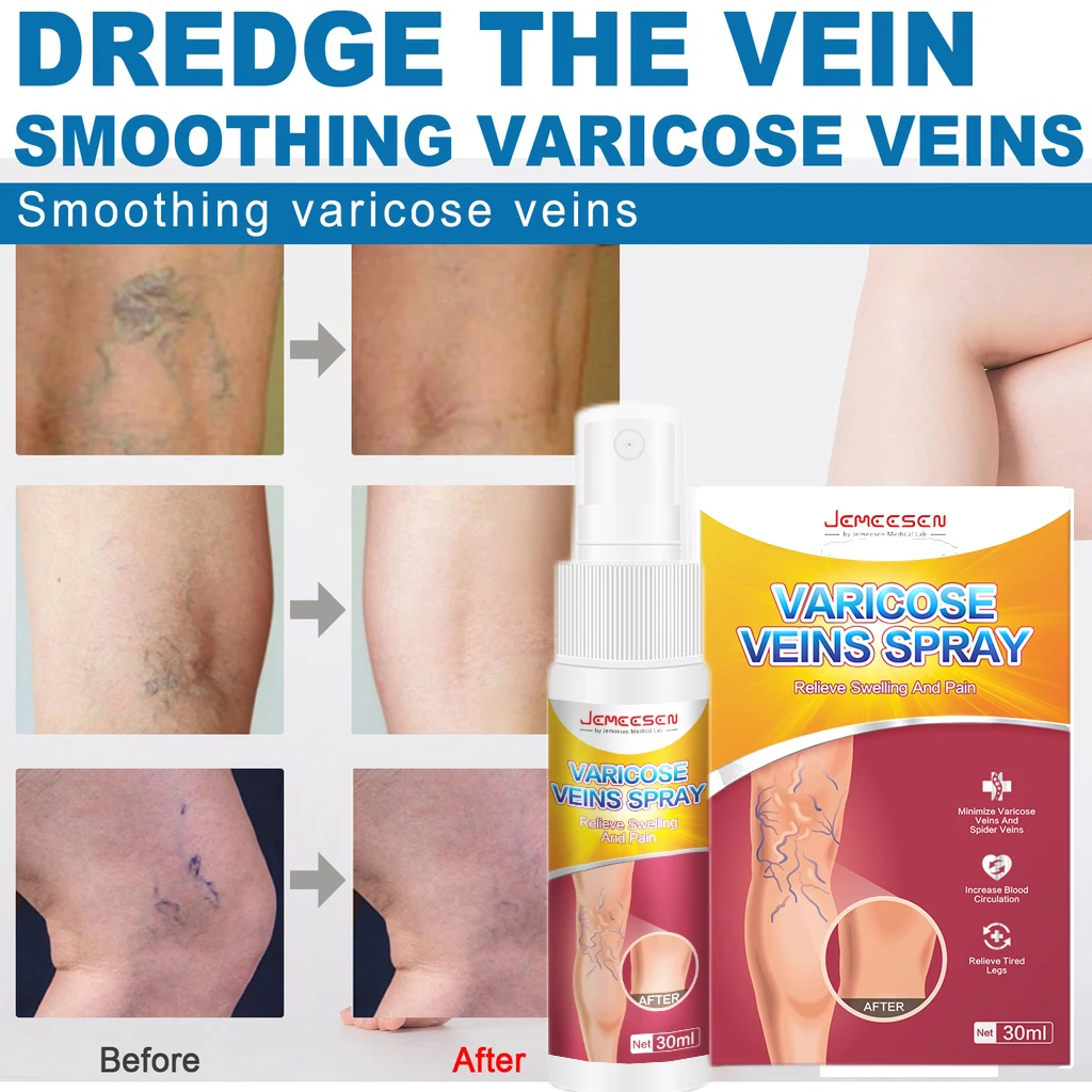 S87f2ffa77b164d7e914127827f791da9H Jemeesen Varicose Vein Spray Relieve Legs Dilated Vasculitis Phlebitis Natural Formula Liquid For Varicose Veins Body Care 30ML