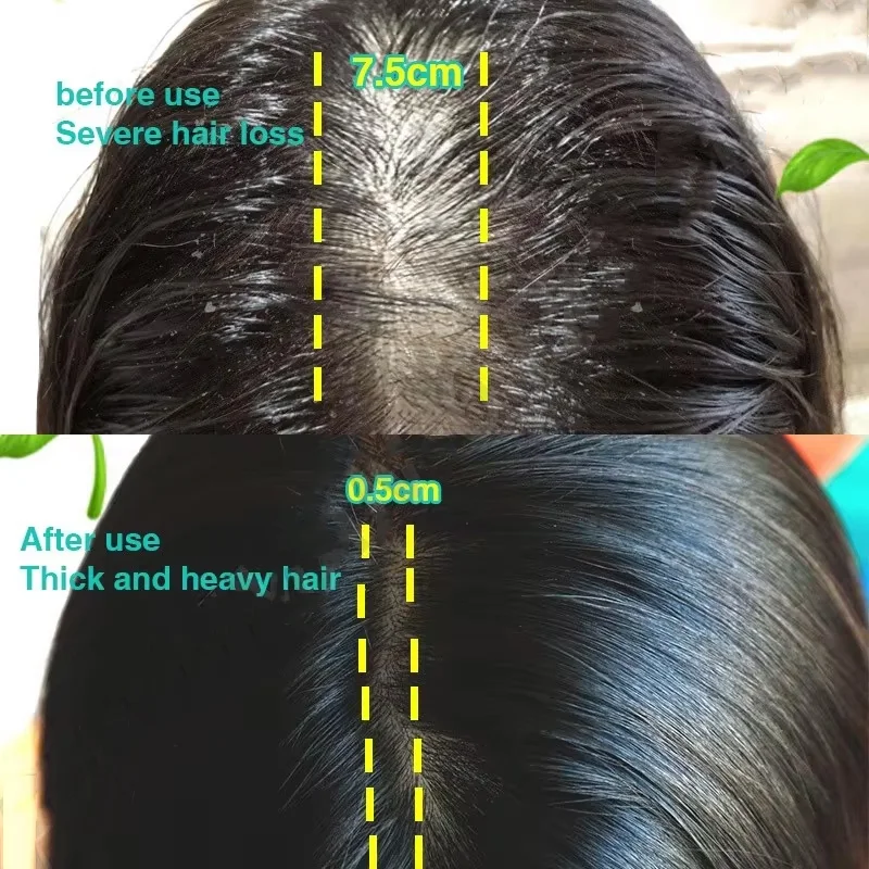 Hair Growth Serum Fast Ginger Hair Growth Spray Anti Hair Loss Regrowth Serum Scalp Damaged Repair Nourish Care for Women Men