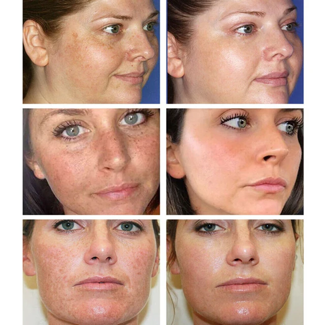 Glutationfehérítő Szeplős Szérum Távolítsa El A Melasma Sötét Foltokat Anti-Acne Anti-Ragyogó Hidratáló C-Vitamin Esszencia Bőrápolás - Image 3