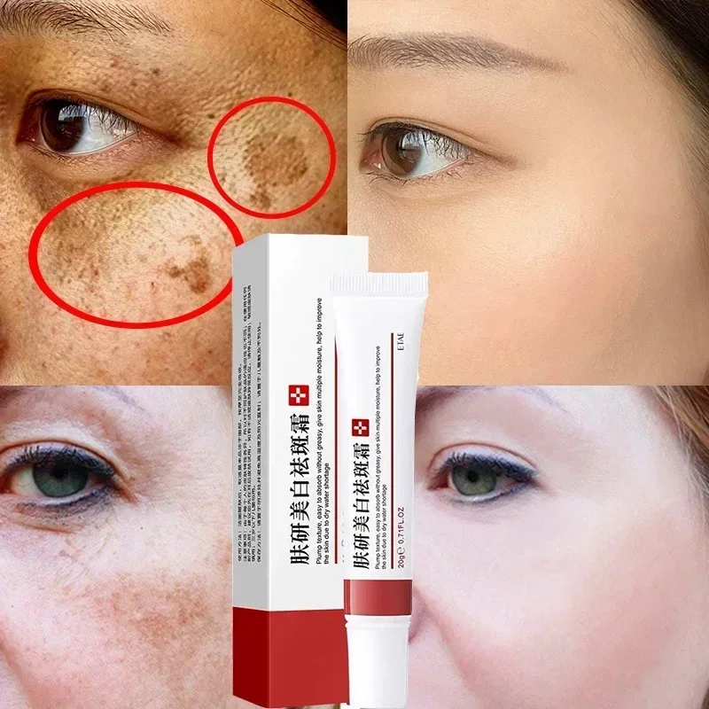 Niacinamide Whitening Cream Remove Dark Spots Anti Aging Freckle Removing Cream Fade Pigmentation Melasma Brighten Gel Skin Care whitening freckle cream remove dark spots anti freckle face creams niacinamide fade pigmentation melasma brighten skin care 20g