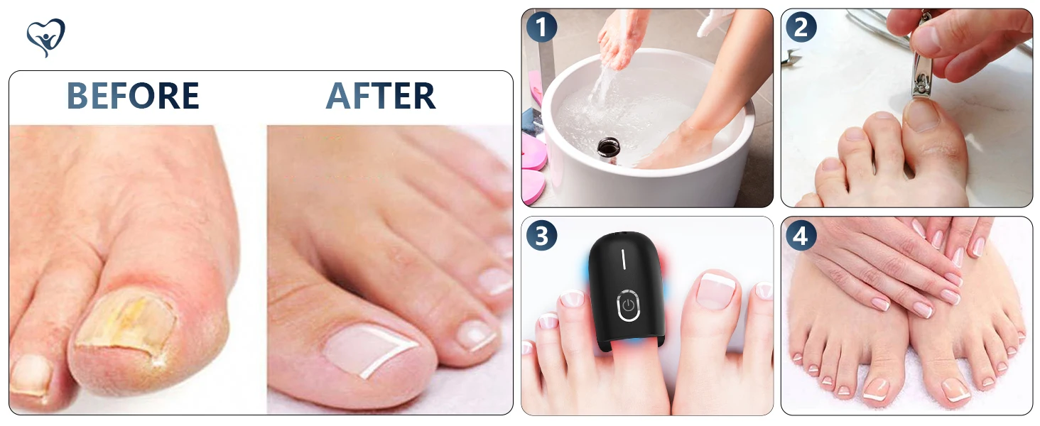 Professionelles Lasergerät Zur Nagelpilzbehandlung Mit Lichttherapie_voghion.com
