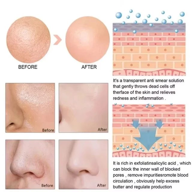 Remove Large Pores Serum Lactic Acid Facial Pore Shrinking Repairing Products Pore Minimizing Firming Smooth Korean Skin Care. 5