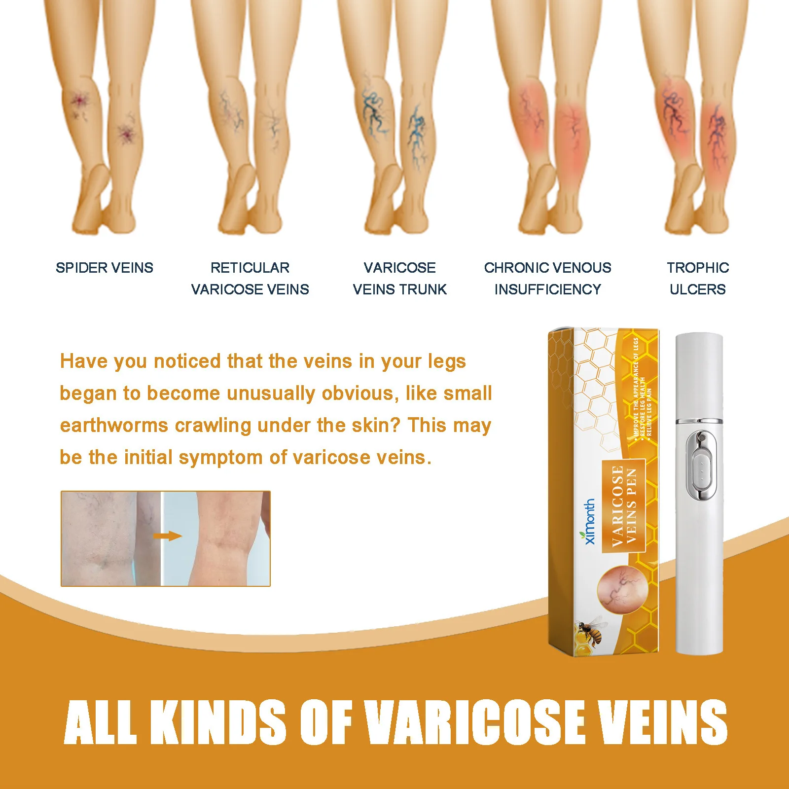 Powerful Laser Therapy Improves Moderate Varicose Veins Relieves Pain Improves Circulation Men Women