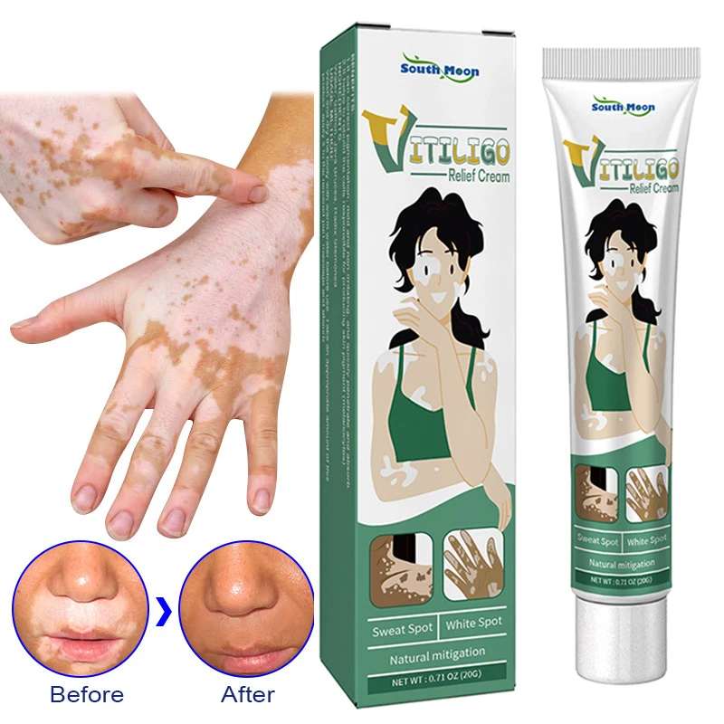 

New Herbal Extract Vitiligo Ointment Remove Ringworm White Spot Removal Skin Vitiligo Eliminate Vitiligo Treatment Cream